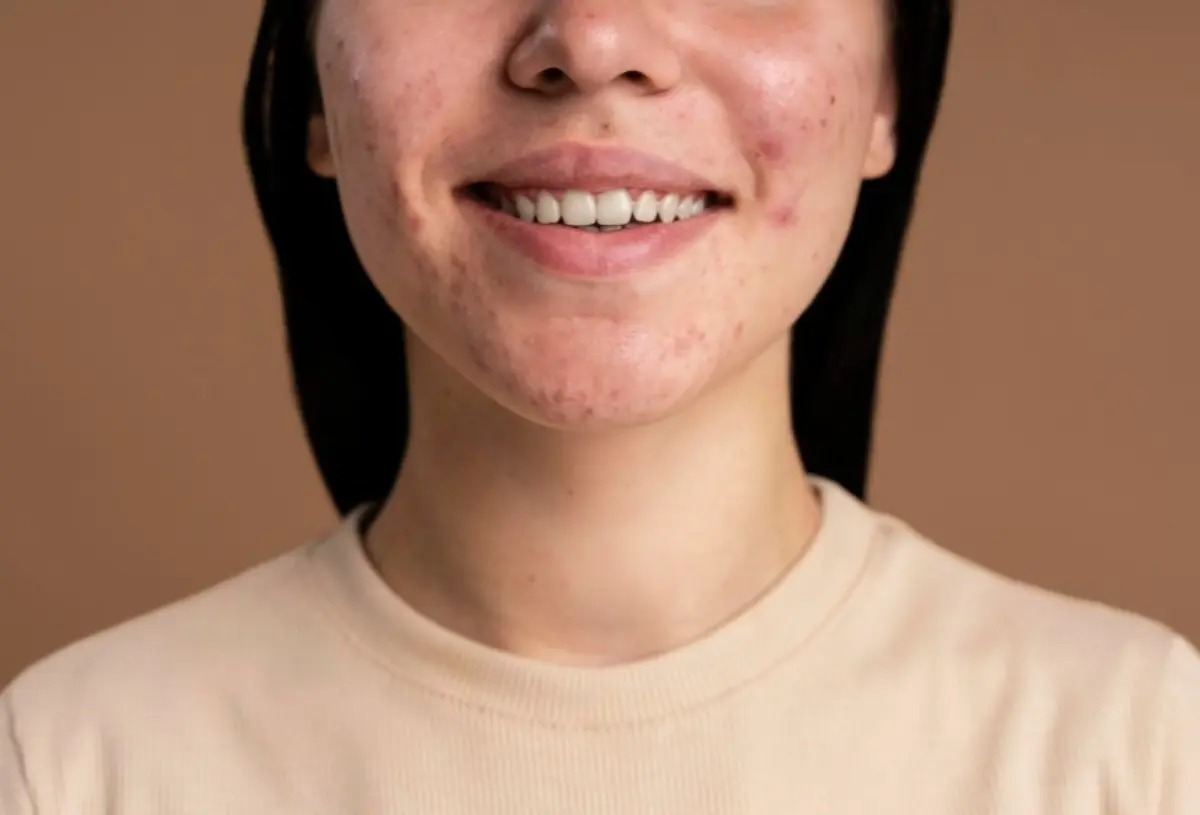 6 Recommended Skincare Products to Effectively Treat Cystic Acne, Backed by Experts