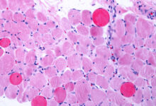 Capricor Cell Therapy Enhances Heart Function in Duchenne Muscular Dystrophy Patients: STAT