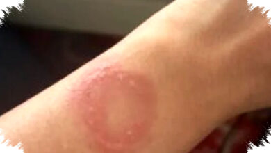 Apple Watch Overheat Causes Severe Burns, Permanent Scars Raise Safety Alarms