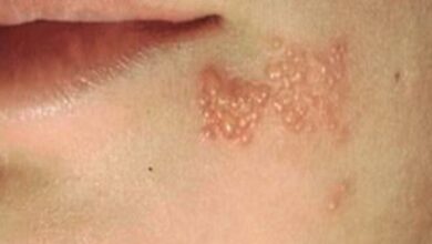 Tips Sehat: Cara Tepat Mencegah Herpes Zoster yang Perlu Anda Ketahui