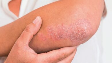 Mengenal Psoriasis: Penyebab, Gejala, dan Cara Penanganan Efektif