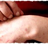 Waspada! Menkes: Campak 18 Kali Lebih Menular dari COVID-19, KLB Mengancam Wilayah