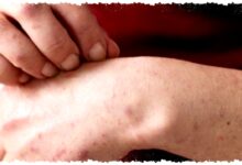 Campak Pada Orang Dewasa Menular? Gejalanya Sering Terlambat Disadari, Ini Faktanya