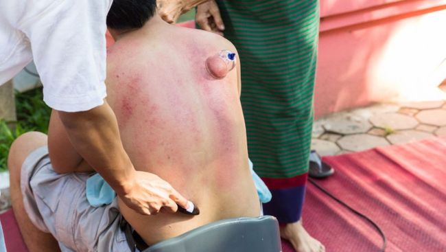 8 Bahaya Kerokan yang Sering Terabaikan, Ternyata Bisa Picu Masalah Serius!