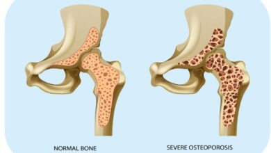 Kenali 5 Tanda Awal Osteoporosis, Cegah Tulang Keropos di Masa Tua