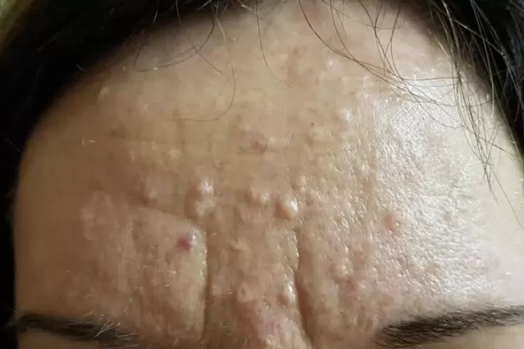 Hiperplasia Sebasea: Kenali Penyebab Benjolan Kecil di Wajah yang Sering Dianggap Sepele Hiperplasia Sebasea: Kenali Penyebab Benjolan Kecil di Wajah yang Sering Dianggap Sepele