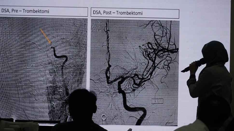 Jangan Lewatkan Detik Penting: Menit Krusial Selamatkan Nyawa Pasien Aritmia dan Stroke
