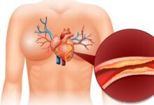 Penyakit Jantung Masih Jadi Pembunuh Utama, Kini Banyak Kasus Bisa Ditangani Tanpa Operasi Besar