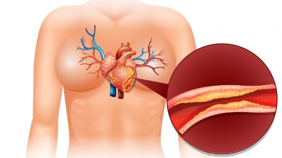 Penyakit Jantung Masih Jadi Pembunuh Utama, Kini Banyak Kasus Bisa Ditangani Tanpa Operasi Besar