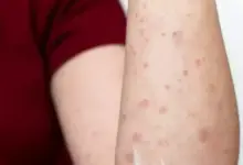 2 WNI di Rumania Positif Kusta, Kasus Pertama dalam 44 Tahun Terakhir Expresi Kekhawatiran