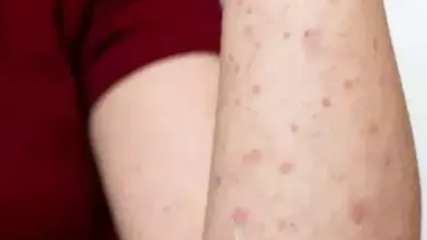 2 WNI di Rumania Positif Kusta, Kasus Pertama dalam 44 Tahun Terakhir Expresi Kekhawatiran