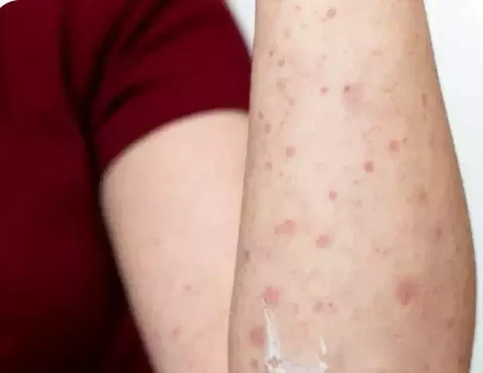 2 WNI di Rumania Positif Kusta, Kasus Pertama dalam 44 Tahun Terakhir Expresi Kekhawatiran