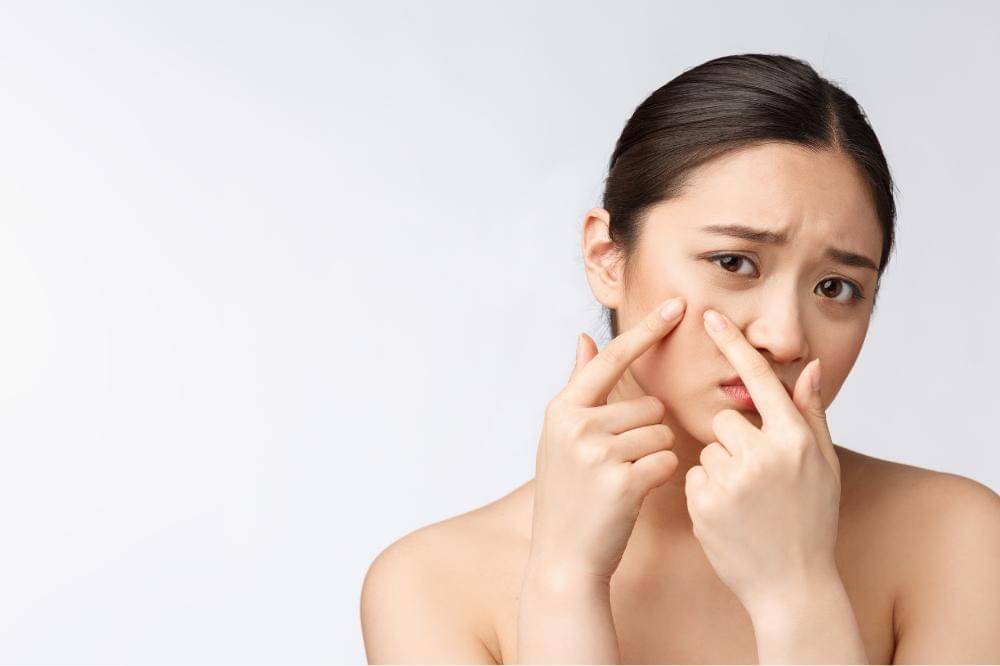 7 Rekomendasi Obat Totol Jerawat Lokal Terbaik untuk Mengatasi Jerawat Membandel