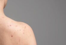 Atasi Jerawat di Punggung dengan 5 Metode Efektif dan Mudah Dilakukan di Rumah