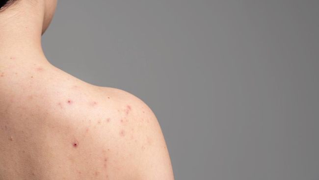 Atasi Jerawat di Punggung dengan 5 Metode Efektif dan Mudah Dilakukan di Rumah