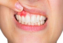 Bahaya Penyakit Gusi pada Ibu Hamil: Risiko Diabetes dan Stroke Meningkat Signifikan