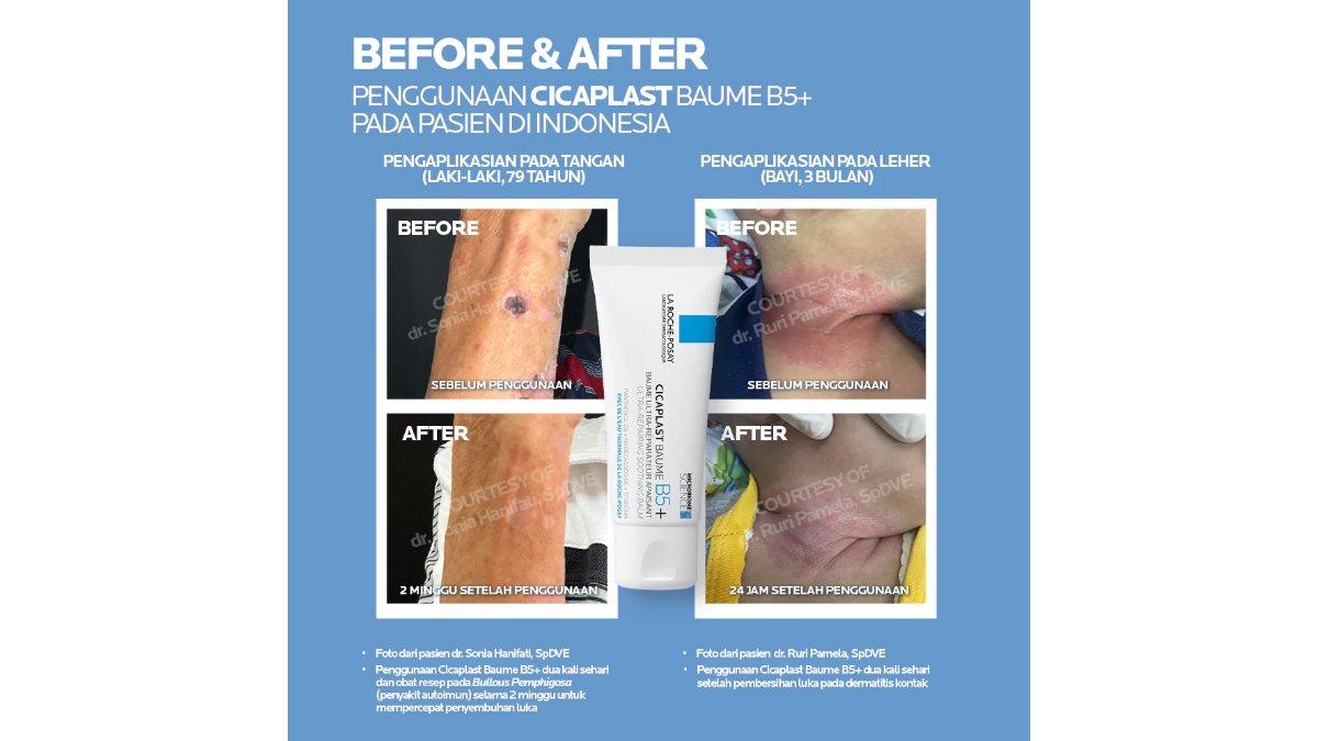 La Roche Posay Cicaplast Baume B5+: Ulasan, Fungsi, dan Hal yang Perlu Diketahui Sebelum Membeli