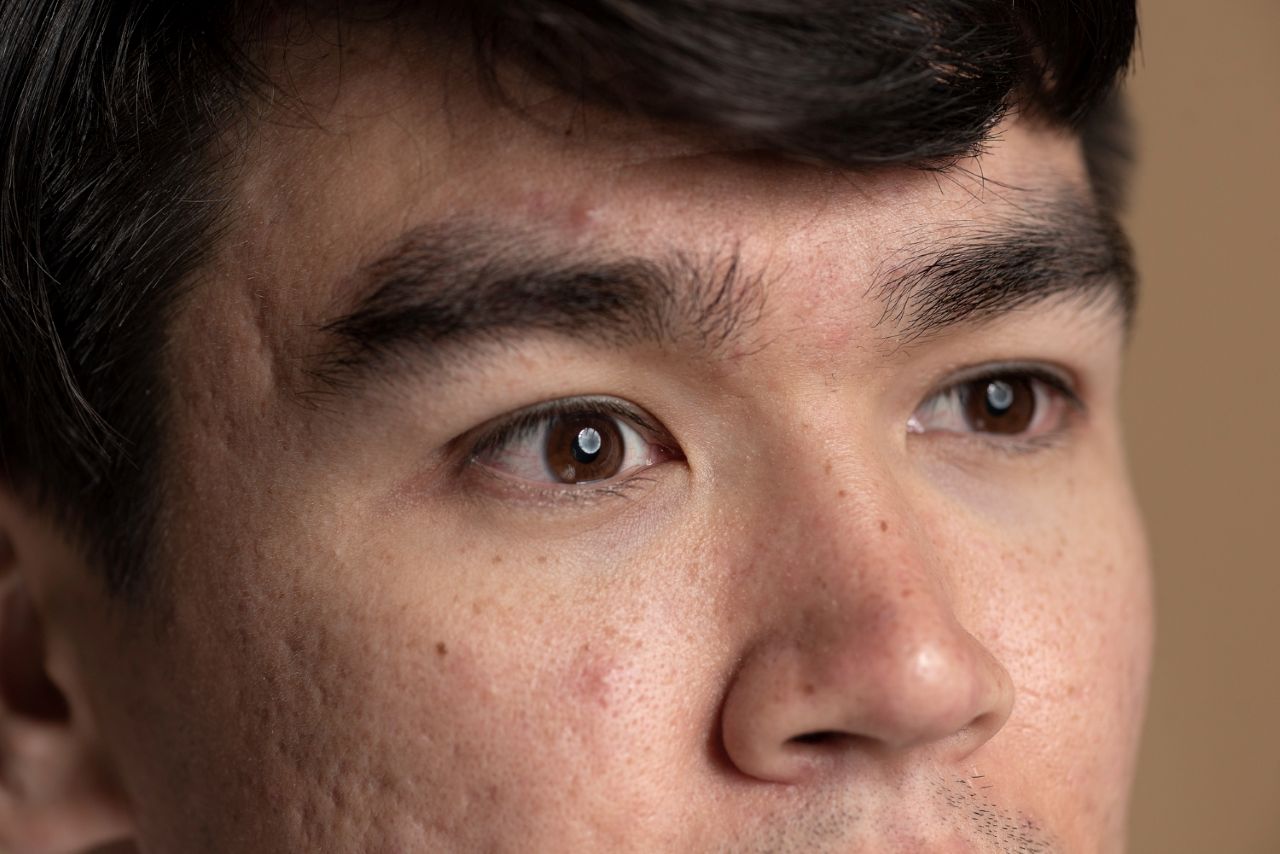 Langkah Efektif Mengatasi Milia di Wajah untuk Kulit Cerah dan Sehat Secara Alami