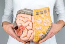 Lonjakan Kasus Radang Usus Kronik di Indonesia: Penyebab Pasien Baru Sadar saat Parah