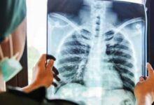 Tantangan Kompleks Bedah Bahu, RS Ini Hadirkan Pakar Dunia Beri Solusi Medis Terbaik