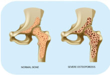 Terlalu Banyak Minum Kopi Tingkatkan Risiko Tulang Lemah pada Wanita Lanjut Usia