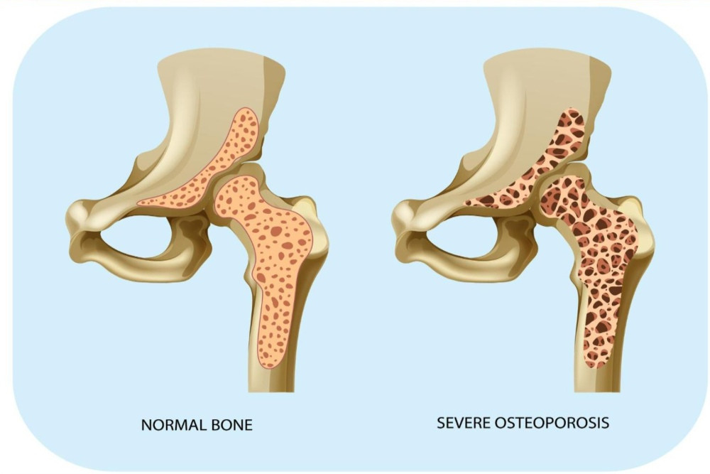 Terlalu Banyak Minum Kopi Tingkatkan Risiko Tulang Lemah pada Wanita Lanjut Usia
