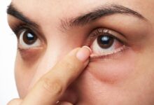 Waspadai Mata Bengkak, Ini Tanda Fungsi Ginjal Bisa Menurun dan Cara Mengatasinya