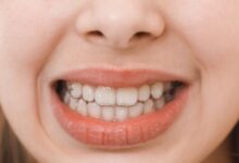 Gigi Goyang Dewasa? Kenali Penyebab dan Cara Mengatasinya Sebelum Parah Terjadi