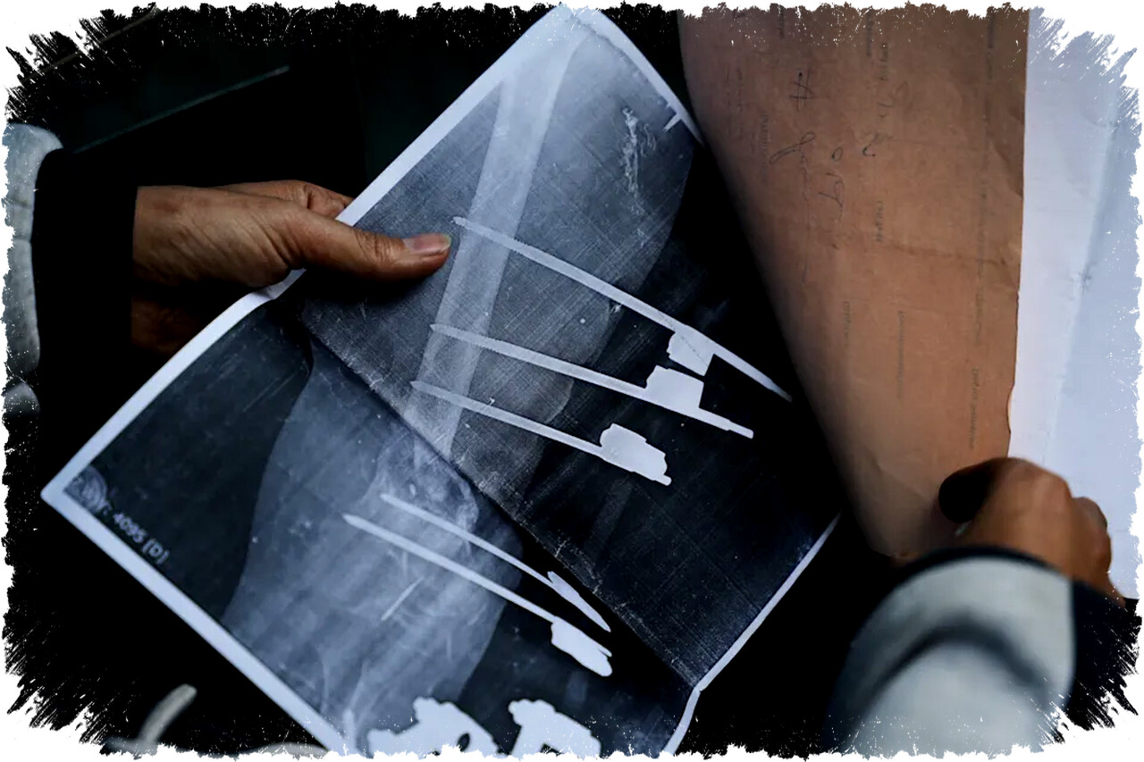 Remaja Gaza Terluka Parah, Kesempatan Jalan Kembali Bergantung pada Pembukaan Perbatasan Rafah