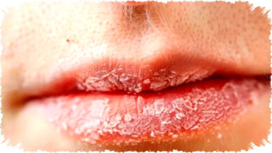 Tips Efektif Atasi Bibir Kering dan Pecah-pecah Saat Puasa Ramadhan dengan Mudah