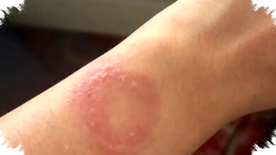 Apple Watch Diduga Membakar Pergelangan, Luka Membekas dan Dukungan Berlarut Berbulan-Bulan