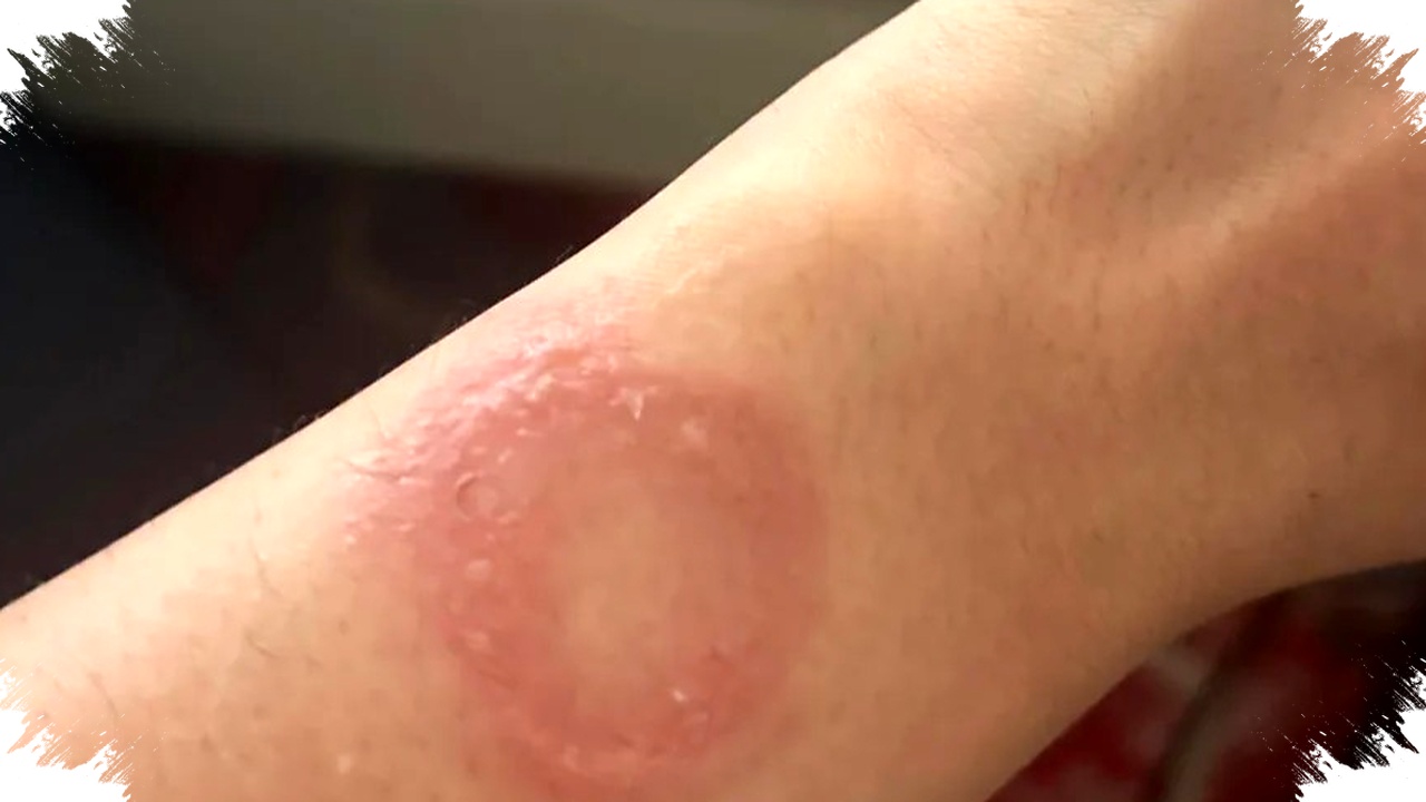 Apple Watch Mendadak Overheat, Luka Bakar Permanen dan Klaim yang Tak Kunjung Tuntas Apple Watch Mendadak Overheat, Luka Bakar Permanen dan Klaim yang Tak Kunjung Tuntas