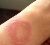 Apple Watch Mendadak Panas dan Membakar Kulit, Luka Permanen dan Penanganan Berlarut-larut Apple Watch Mendadak Panas dan Membakar Kulit, Luka Permanen dan Penanganan Berlarut-larut