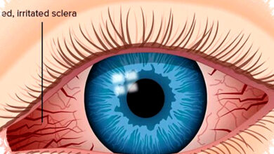 Jangan Anggap Sepele Kalazion, Kenali Gejala Dan Cara Mengobatinya Dengan Tepat