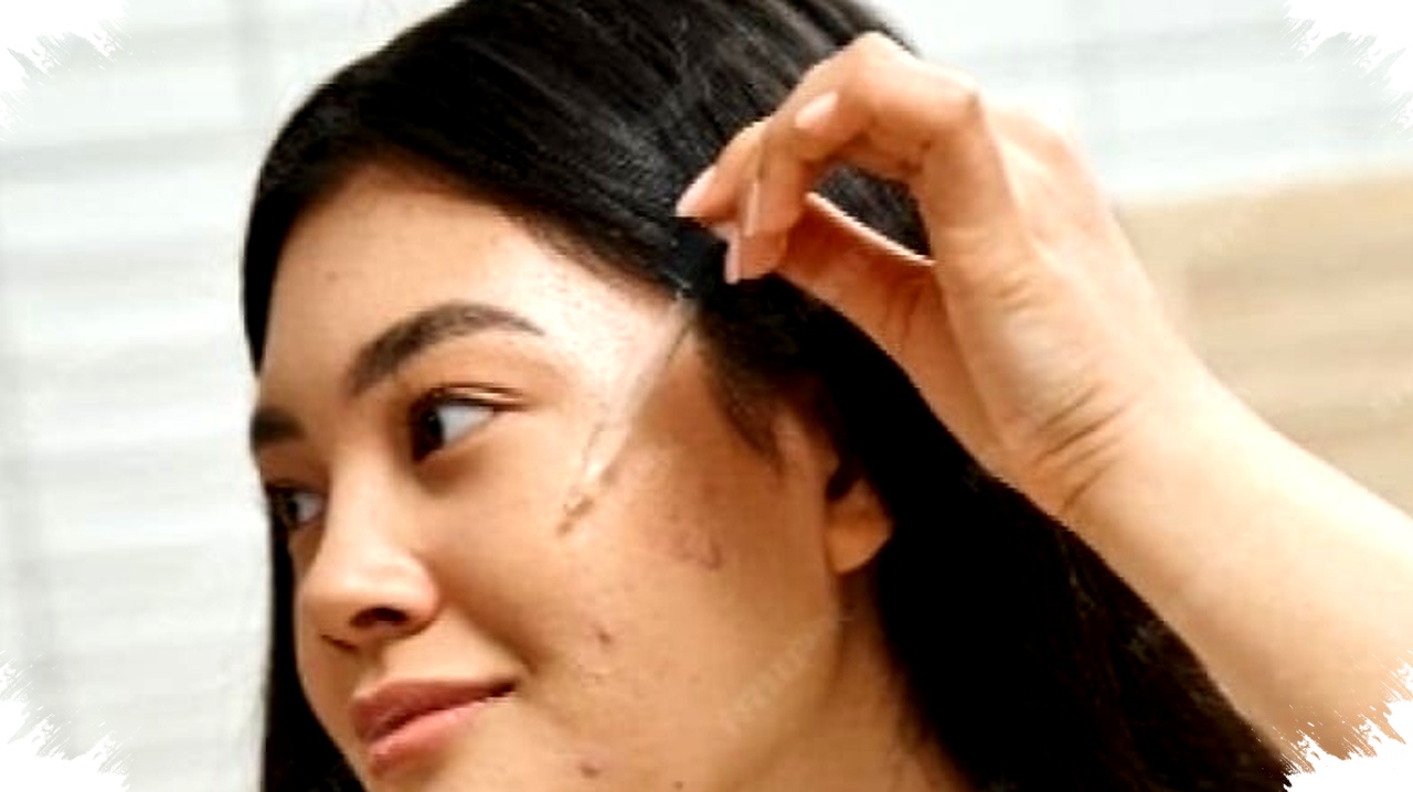 Jerawat Muncul Setelah Lebaran, 4 Acne Serum Ini Paling Layak Dicoba Jerawat Muncul Setelah Lebaran, 4 Acne Serum Ini Paling Layak Dicoba