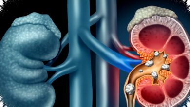 Pilihan Terapi Efektif untuk Mengatasi Anemia pada Pasien Penyakit Ginjal Kronis