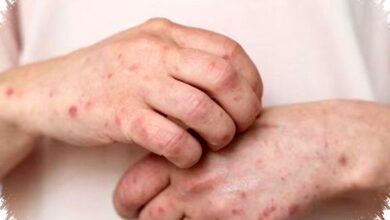 Tren Kasus Campak Maret 2026 Melonjak Turun Drastis, Bagaimana Kunci Keberhasilannya?