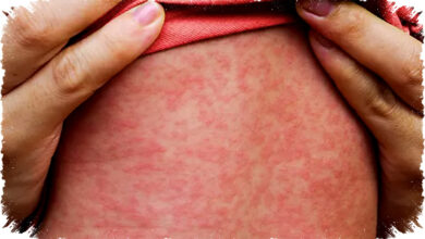 Waspada Tiga Fase Gejala Campak, Kenali Tandanya dan Cegah KLB Dengan Imunisasi Tepat Jadi Penyelamat