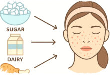 5 Makanan Harian Pemicu Jerawat Dan Komedo, Banyak Orang Tak Sadar Ada Di Meja Makan