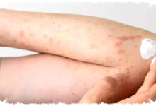 Demam Tinggi Atau Ringan, Cara Tepat Membedakan Campak dan Rubela Sejak Awal