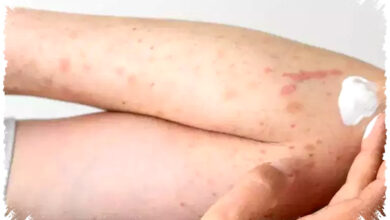 Demam Tinggi Atau Ringan, Cara Tepat Membedakan Campak dan Rubela Sejak Awal Demam Tinggi Atau Ringan, Cara Tepat Membedakan Campak dan Rubela Sejak Awal