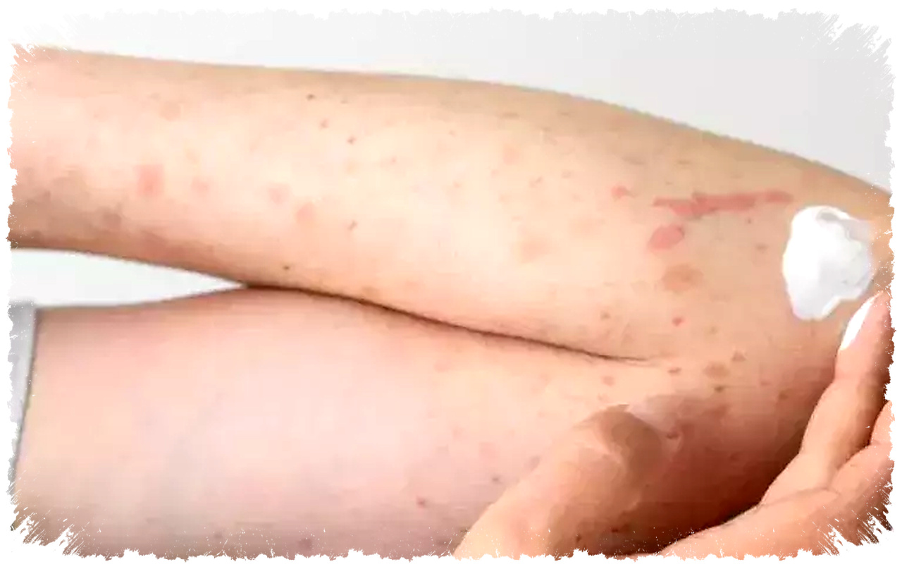 Demam Tinggi Atau Ringan, Cara Tepat Membedakan Campak dan Rubela Sejak Awal