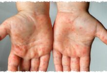 Jabar Siaga Campak 2026, Gejala Awal dan Langkah Cegah yang Menentukan