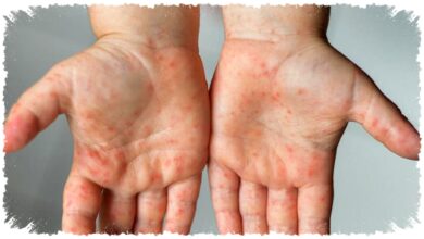 Jabar Siaga Campak 2026, Gejala Awal dan Langkah Cegah yang Menentukan