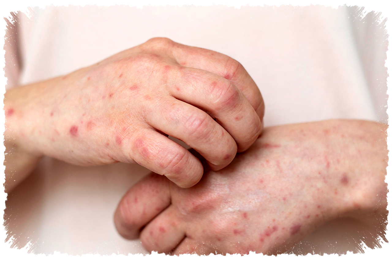 Jejak Sifilis Kuno di Vietnam Mengguncang Teori Asal Usulnya, Bukan Dari Amerika? Jejak Sifilis Kuno di Vietnam Mengguncang Teori Asal Usulnya, Bukan Dari Amerika?