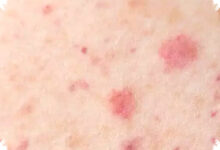 Kemenkes Keluarkan Surat Edaran Waspada Campak, Tenaga Medis Jadi Garda Terdepan