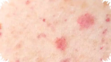 Kemenkes Keluarkan Surat Edaran Waspada Campak, Tenaga Medis Jadi Garda Terdepan